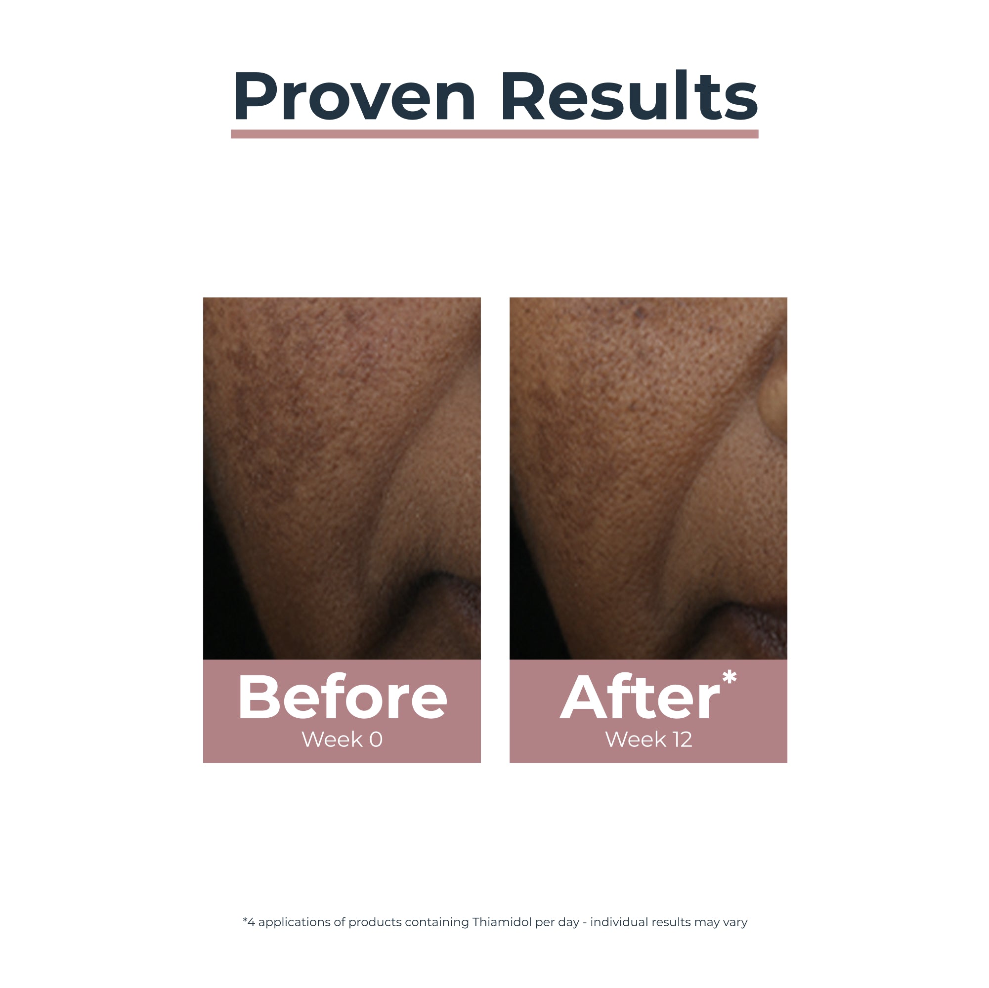 Eucerin Anti-Pigment Stick Corretor de Manchas 5ml